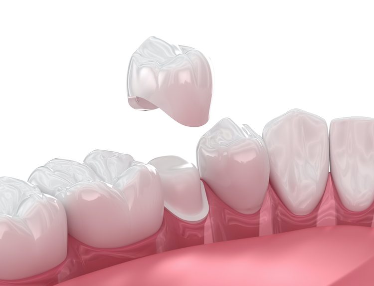 Dentists often recommend dental crowns to help preserve the natural structure of your tooth or complete additional treatments.